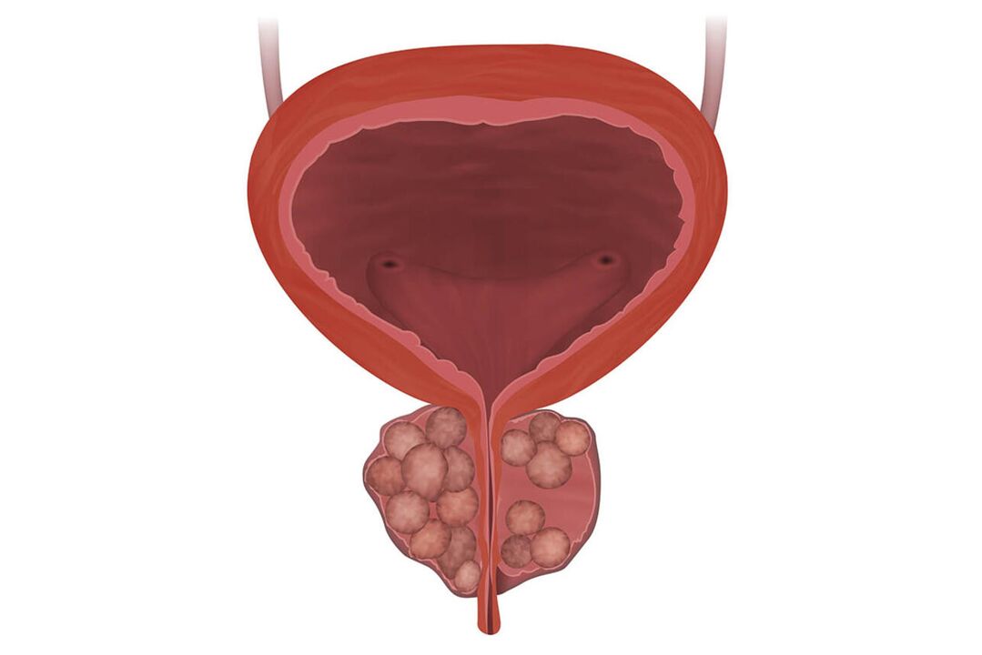 Symptome einer Prostatitis
